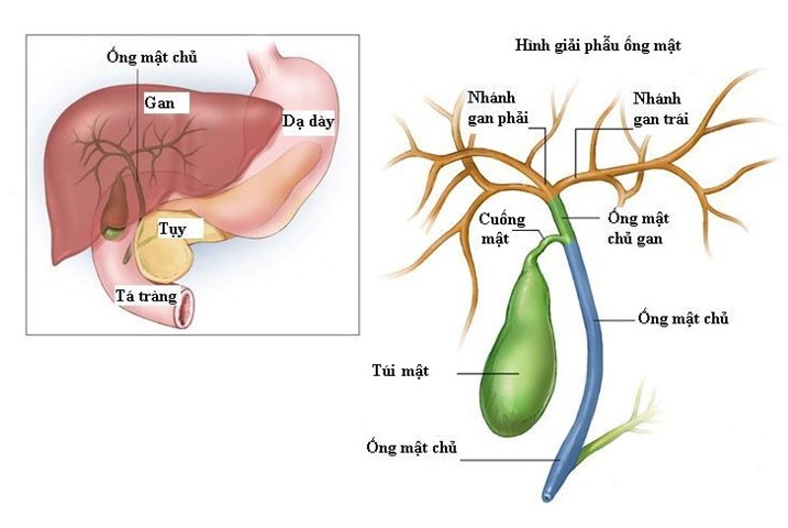 Viêm đường mật cấp